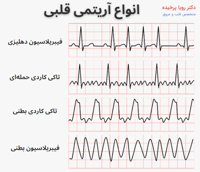 انواع آریتمی قلبی