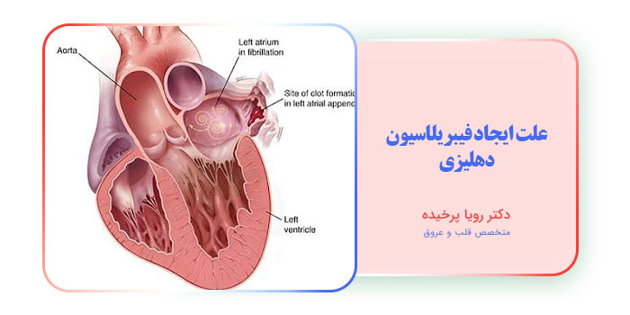 علت ایجاد فیبریلاسیون دهلیزی