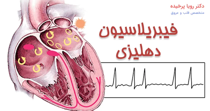 فیبریلاسیون دهلیزی