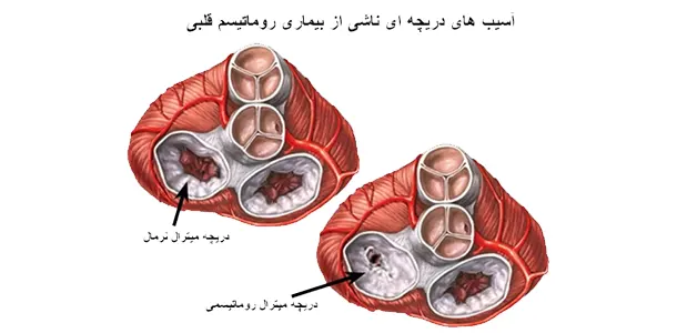 بیماری روماتیسم قلبی