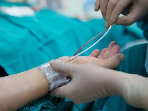 آنژیوگرافی از راه دست