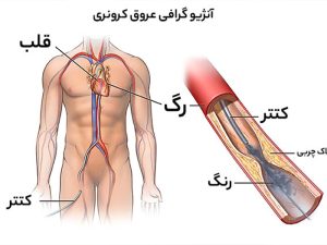 آنژیوگرافی عروق کرونری